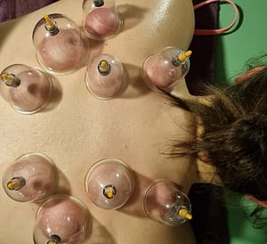 Cupping session on somebody's back